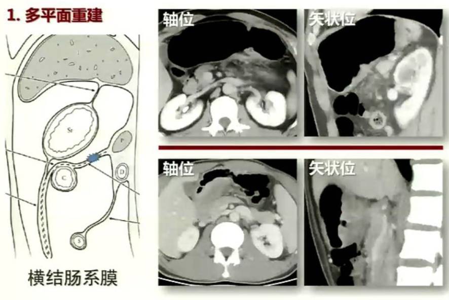 胃癌腹膜转移诊断攻略