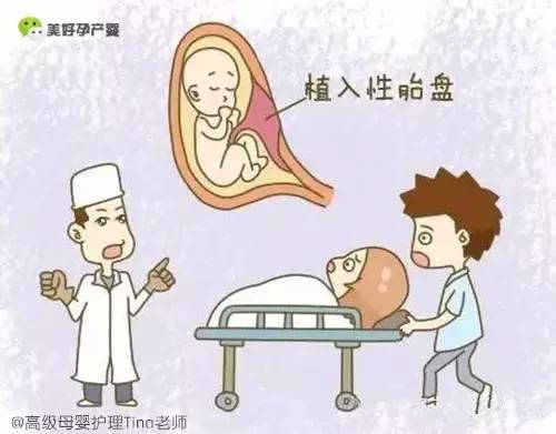 不要忽视胎盘植入 可导致产后大出血