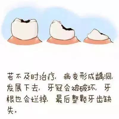 揭秘:蛀牙就是牙里长虫子?