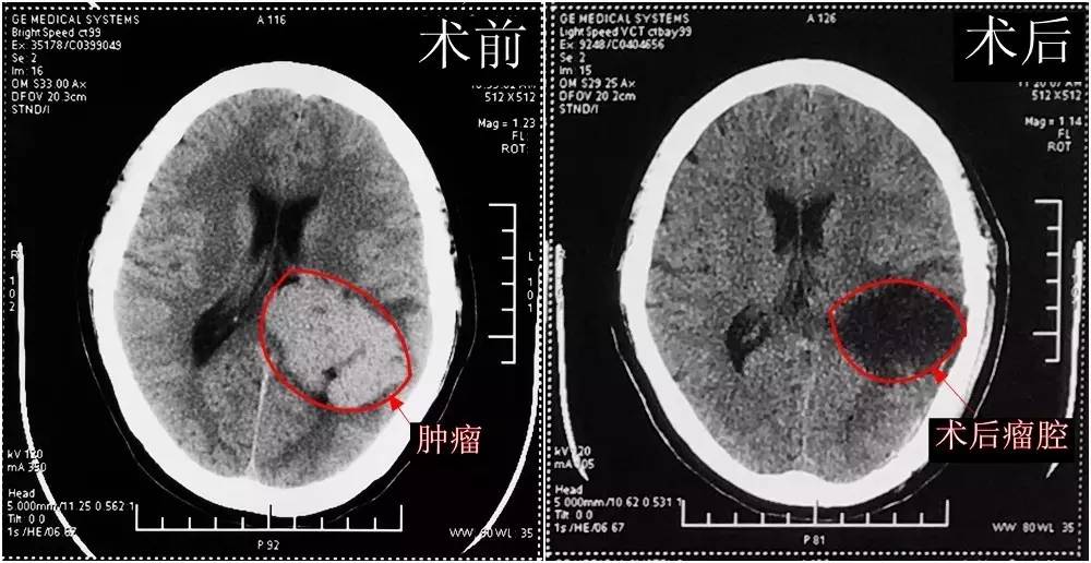 市人民医院成功完成高难度巨大左侧脑室三角区脑膜瘤切除术,专家提醒