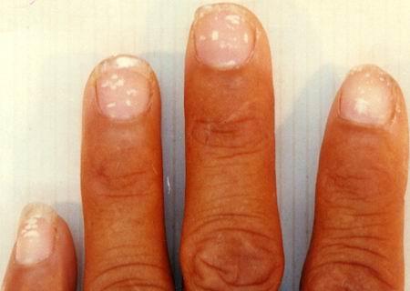 指甲下有红斑点出现,说明毛细 血 管 出 血,其成因可能是由于高 血 压