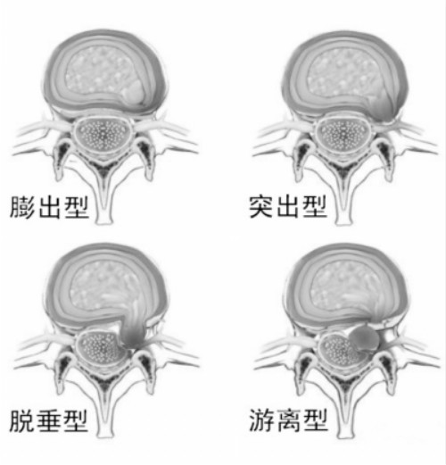 腰间盘突出保守治疗用什么方法最好