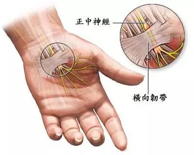 "鼠标手"通常指  腕管综合征,是正中神经在腕部受压导致的一系列症状