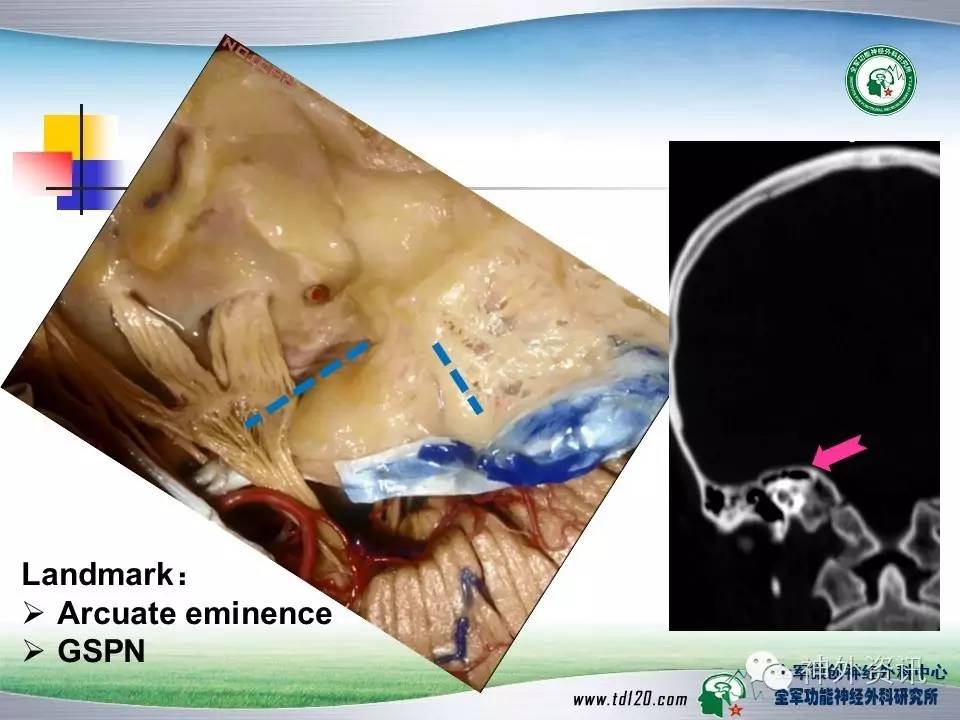 【正海-妙术视界 贺世明教授:经中颅窝入路内听道听神经瘤切除术