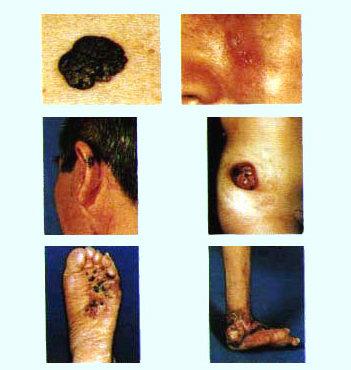 皮肤鳞状细胞癌的诊治
