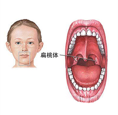 一,扁桃体发炎的病因病机 扁桃体炎是儿童和青少年的常见病.