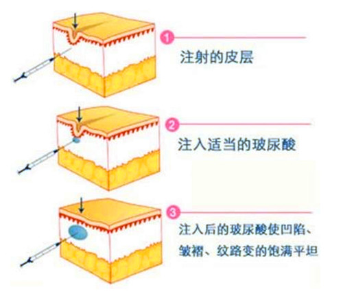 玻尿酸注射的优势