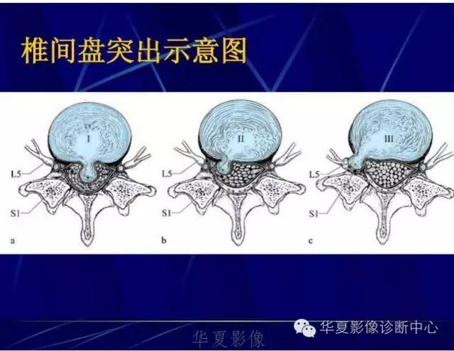 详细的腰椎解剖,椎间盘突出,膨出,看这里