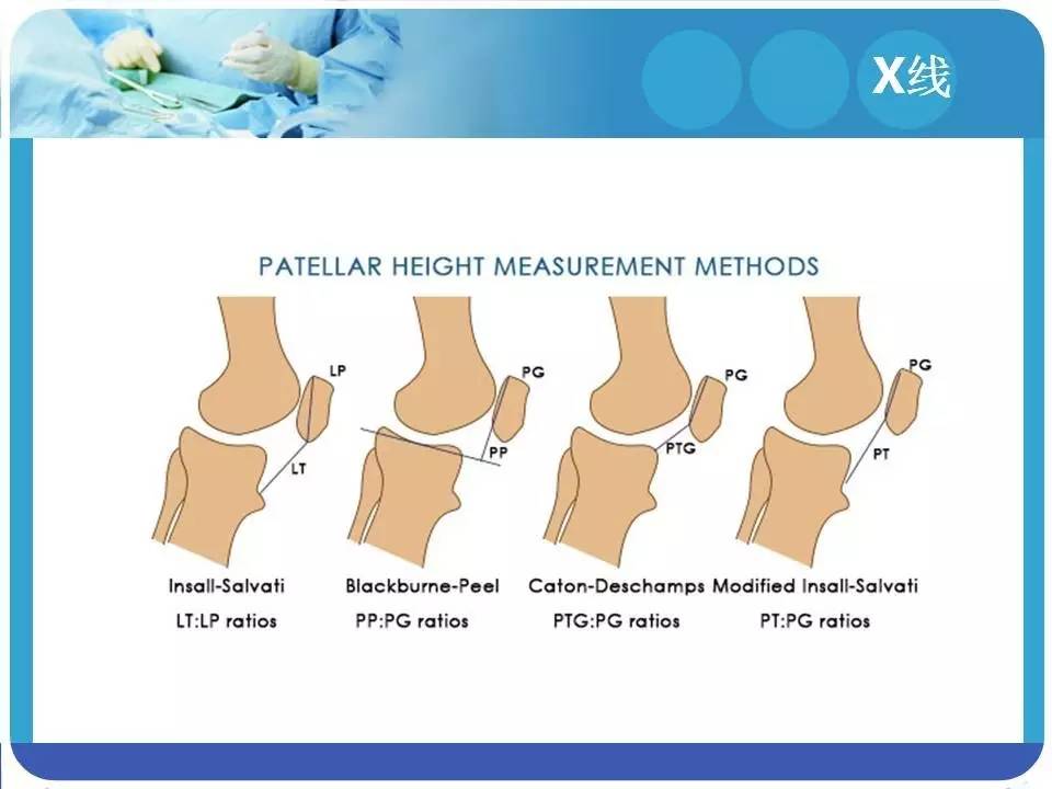 精彩幻灯:高位髌骨的诊断和治疗