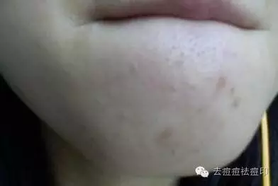 痘痘肌毛孔粗大怎么办