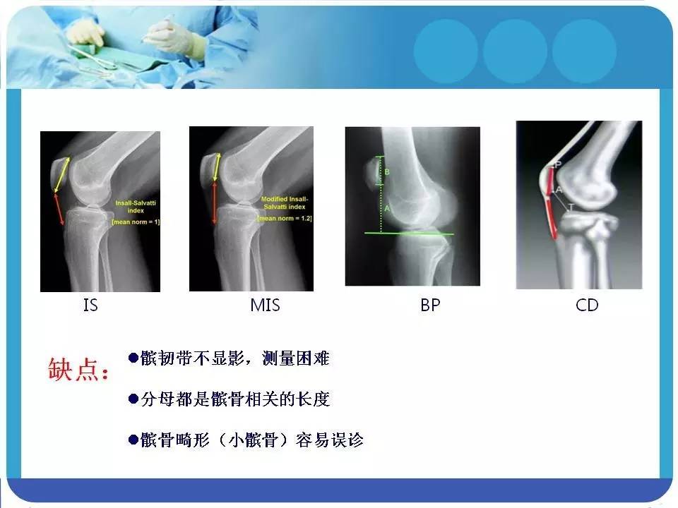 精彩幻灯:高位髌骨的诊断和治疗