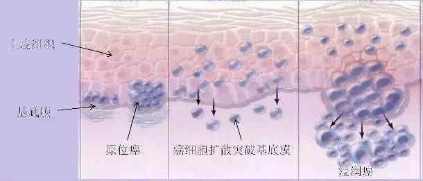 理性关注病理报告单上的肿瘤"信息",提高对癌症的警惕,可有效加强预防