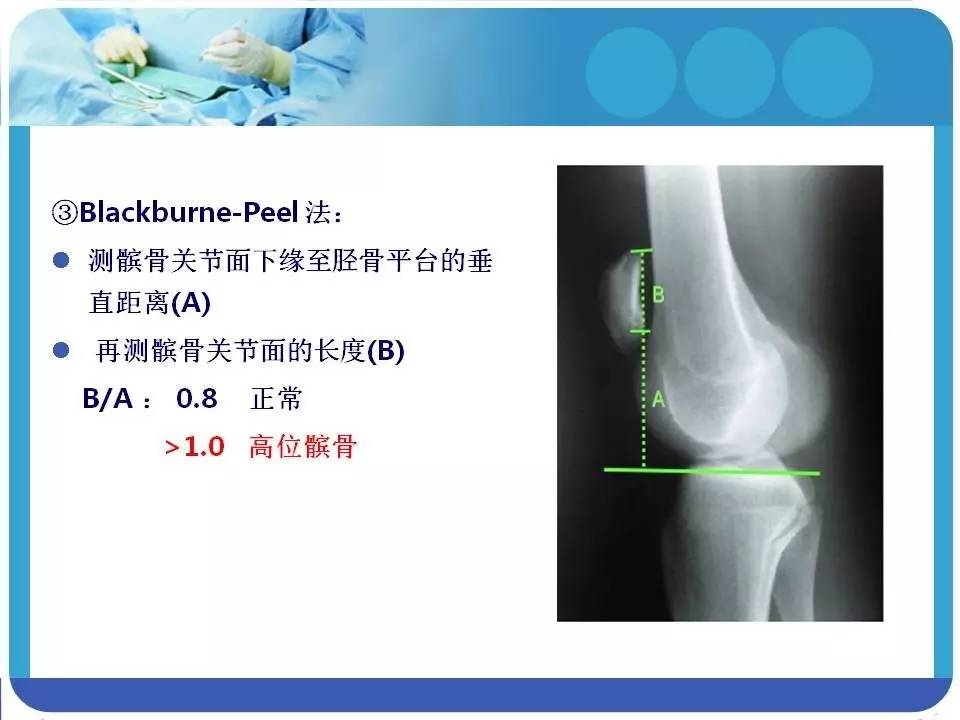 精彩幻灯:高位髌骨的诊断和治疗
