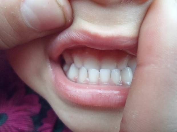 宝宝乳牙齿反颌了,家长们有及时发现么?