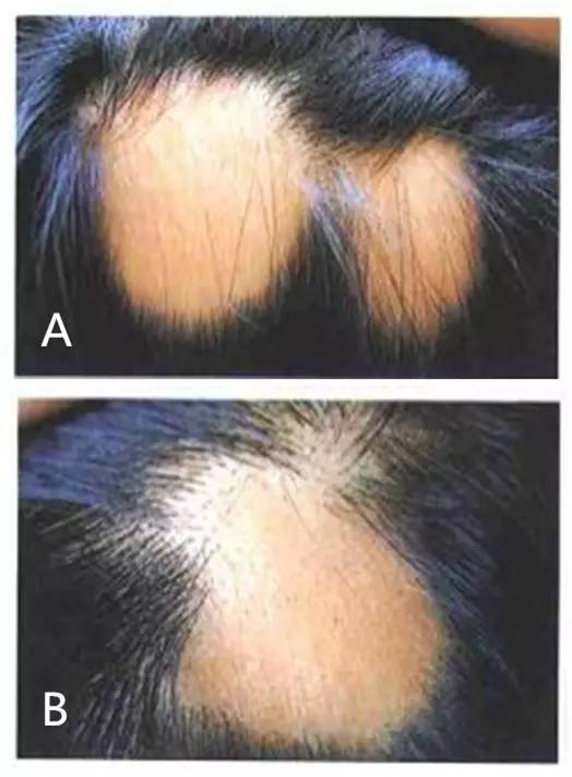 少年秃顶关于儿童斑秃不得不说的事儿