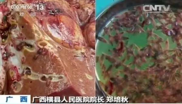 ▼ 每年有1200万中国人感染肝吸虫 肝吸虫在人体内 可存活20~30年,可
