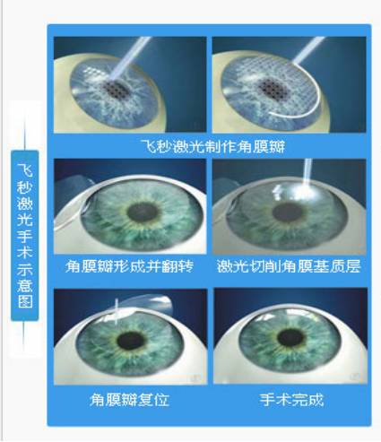 手术治疗近视眼的原理_MCT技术控制近视 非手术治疗近视的首选