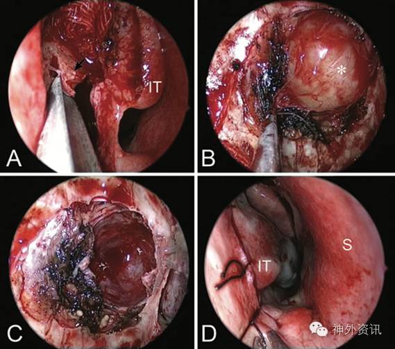 鼻内镜下泪前隐窝入路切除翼腭窝,颞下窝神经鞘瘤