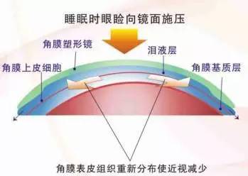 塑形镜的原理_△角膜塑形镜视力矫正原理