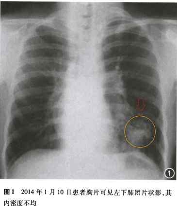 太复杂了,竟然是结核性肺脓肿!