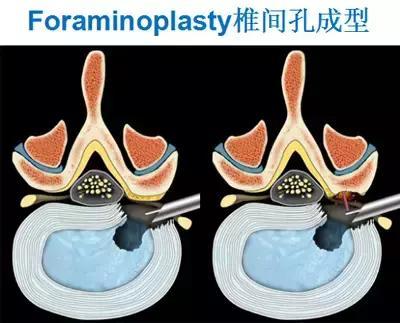 经椎间孔脊柱内镜技术