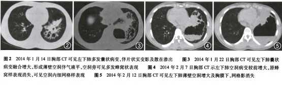 太复杂了竟然是结核性肺脓肿