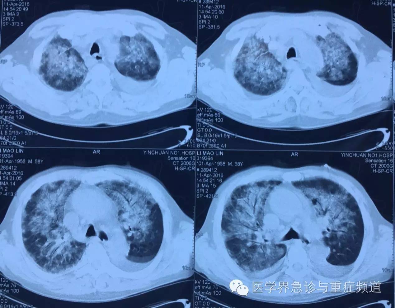 入我院时肺部 ct (8-30)血气分析:(fio250%):ph7.