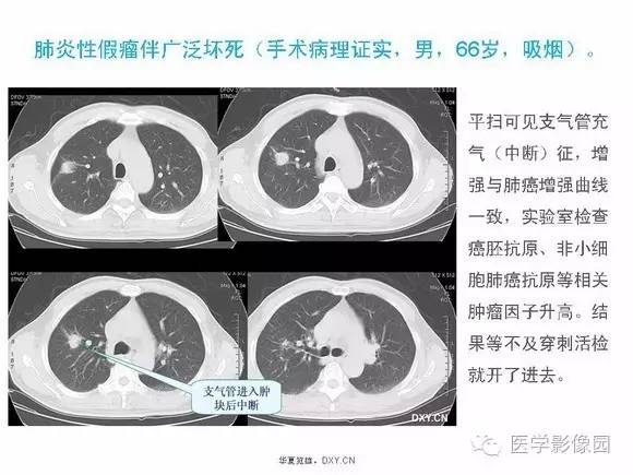 干货一文鉴别肺炎结核与肺部肿瘤