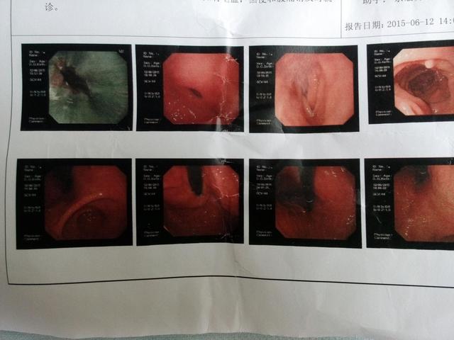 慢性胃炎有很多的临床症状,主要表现为食欲减退,恶心,嗳气,上腹部