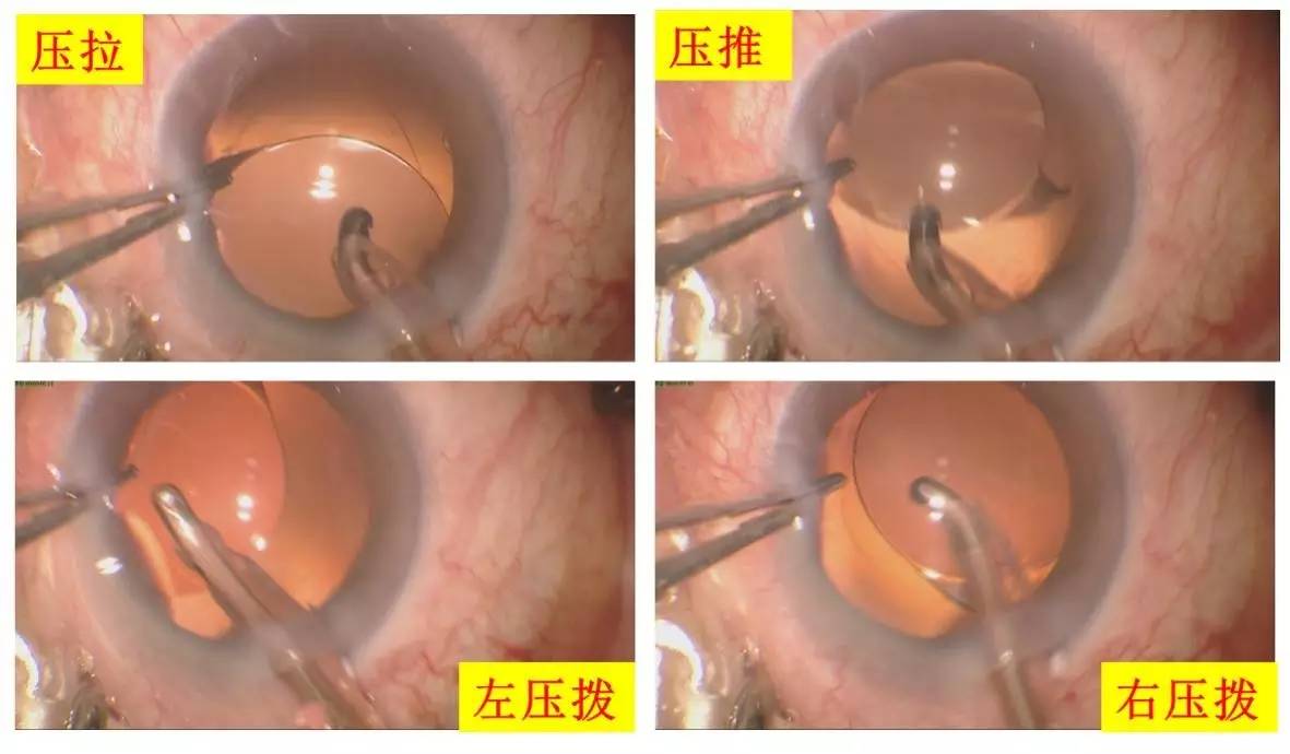 褚涛:如何做一台极尽完美的白内障手术——前,后囊