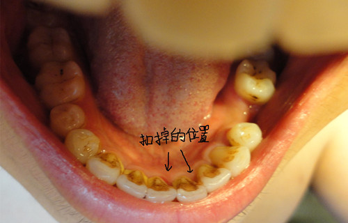 牙齿内侧黄黄的脏东西怎么去除?