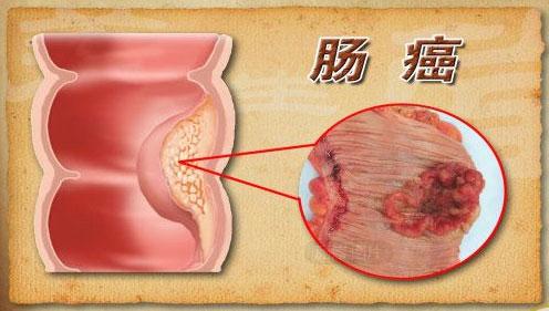 肠道出现这些症状时要警惕,可能是大肠癌!