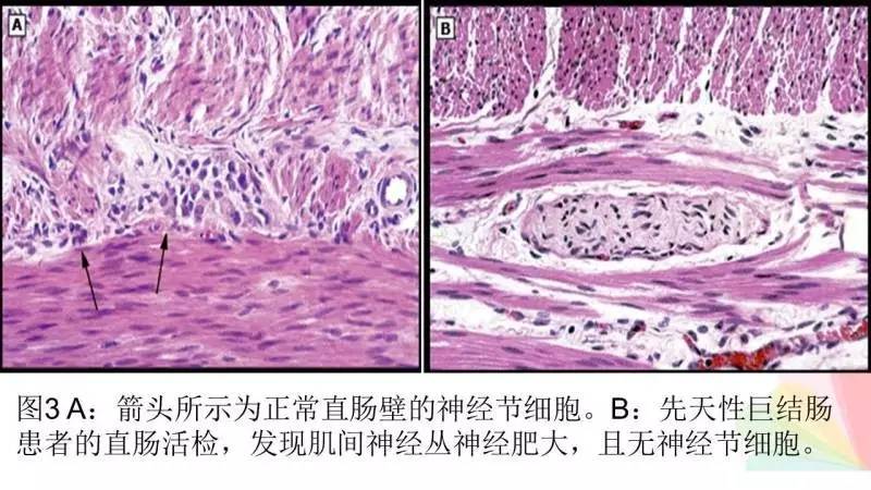 直肠壶腹部空虚,肛管狭窄呈戒指样感觉,病程长,符合先天性巨结肠,病理