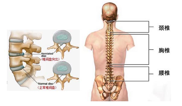 腰间盘突出的症状最佳治疗方法是什么呢?-传媒