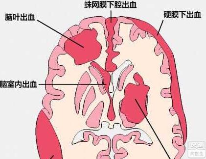 统称基底节区出血.