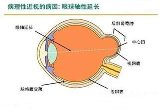 眼球突出,警惕病理性高度近视