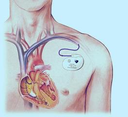 健康 正文  不少老年人因为各种心脏原因植入了永久性起搏器,随着症状