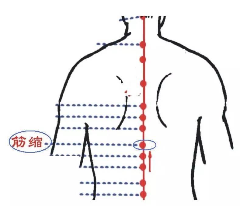 49,腰椎盘突出穴——筋缩