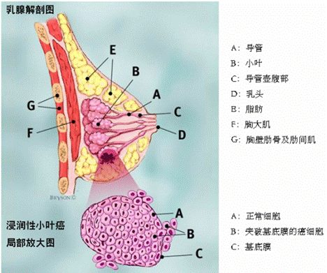 乳腺3期浸润性导管癌诊疗指南