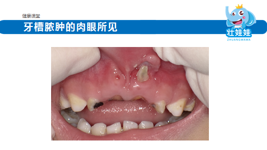 第四个危害就是会影响恒牙的健康,表现为以下几个方面.