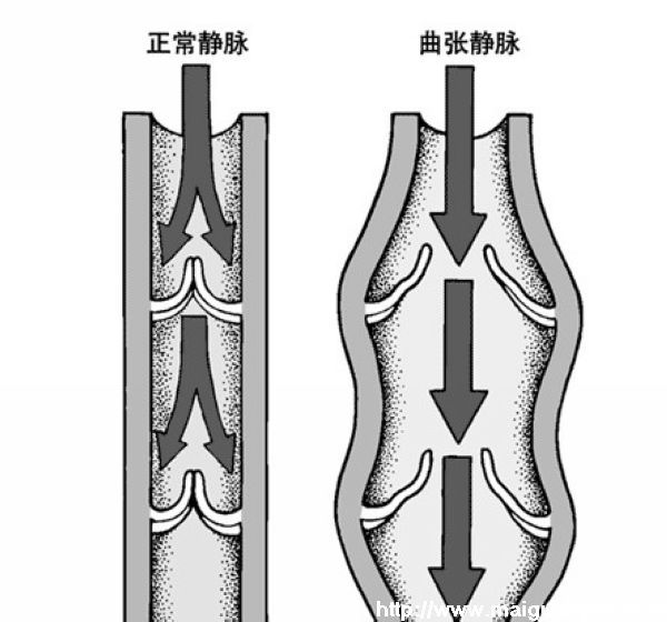 下肢静脉内有许多类似我国农村水车的隔板样的瓣膜,如果瓣膜损坏,腿部