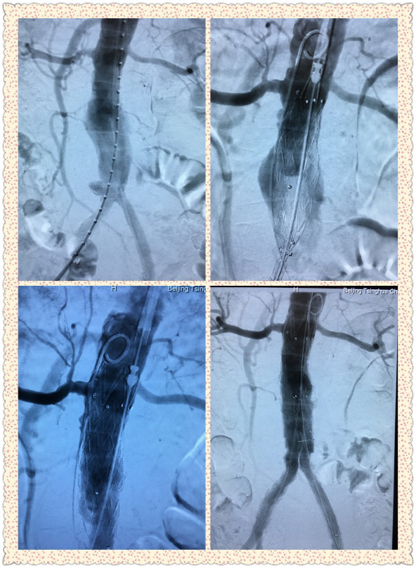 清华长庚血管外科引进最新覆膜支架治疗腹主动脉瘤