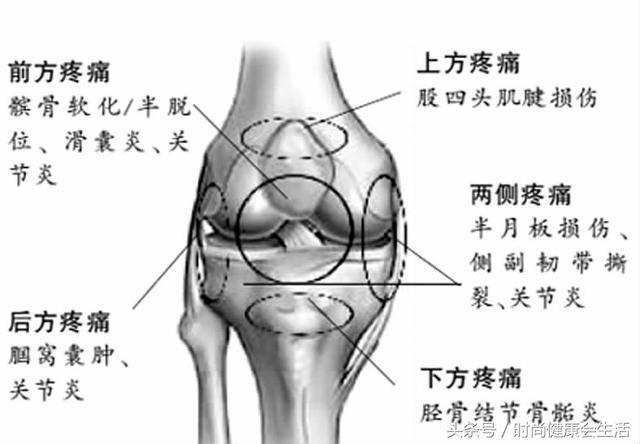 引起脂肪垫充血,肥厚并发生炎症,与髌韧带发生粘连,从而使膝关节活动