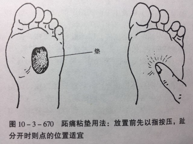 鞋子合不合适只有脚知道—跖痛病