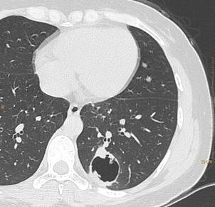 肺转移瘤的13个不典型表现(上)