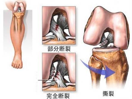 前交叉韧带损伤的急性期表现为:因为关节内出血导致肿胀,疼痛,屈伸