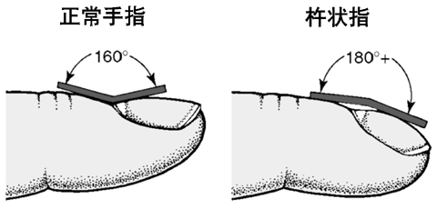 杵状指是一个缓慢的过程,发生在很多年里.