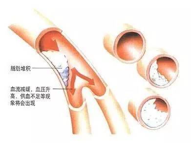 高脂血症