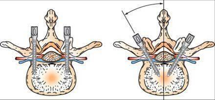 椎弓根螺钉内固定强直性脊柱炎后凸畸形分析