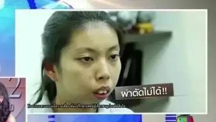 泰国龅牙妹矫正一个月后,从丑女变校园女神!